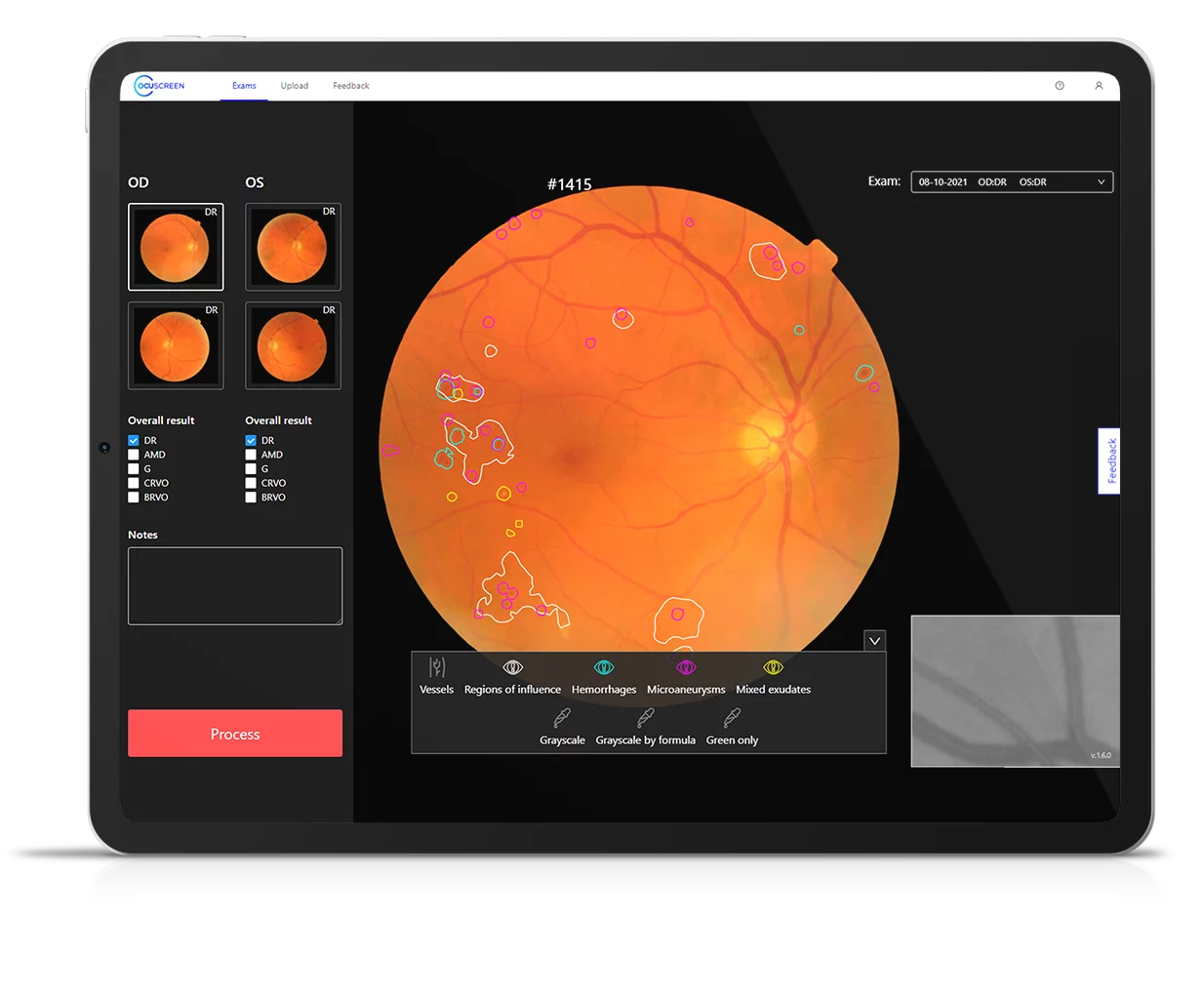 OCUSCREEN программа