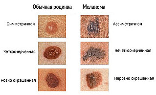 Профилактика меланомы