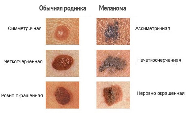 Профилактика меланомы