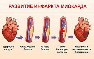 Внимание: инфаркт!