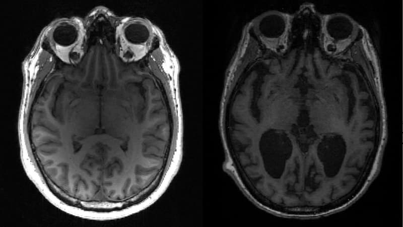 Depuis vingt ans, il échappe contre toute attente à la maladie d'Alzheimer: ce cas qui intrigue les scientifiques