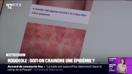 La rougeole gagne du terrain et inquiète les autorités sanitaires