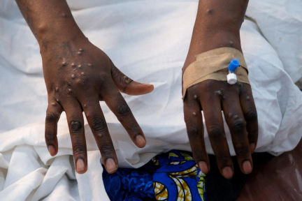 Premier cas de la souche clade 1b du Mpox au Royaume-Uni